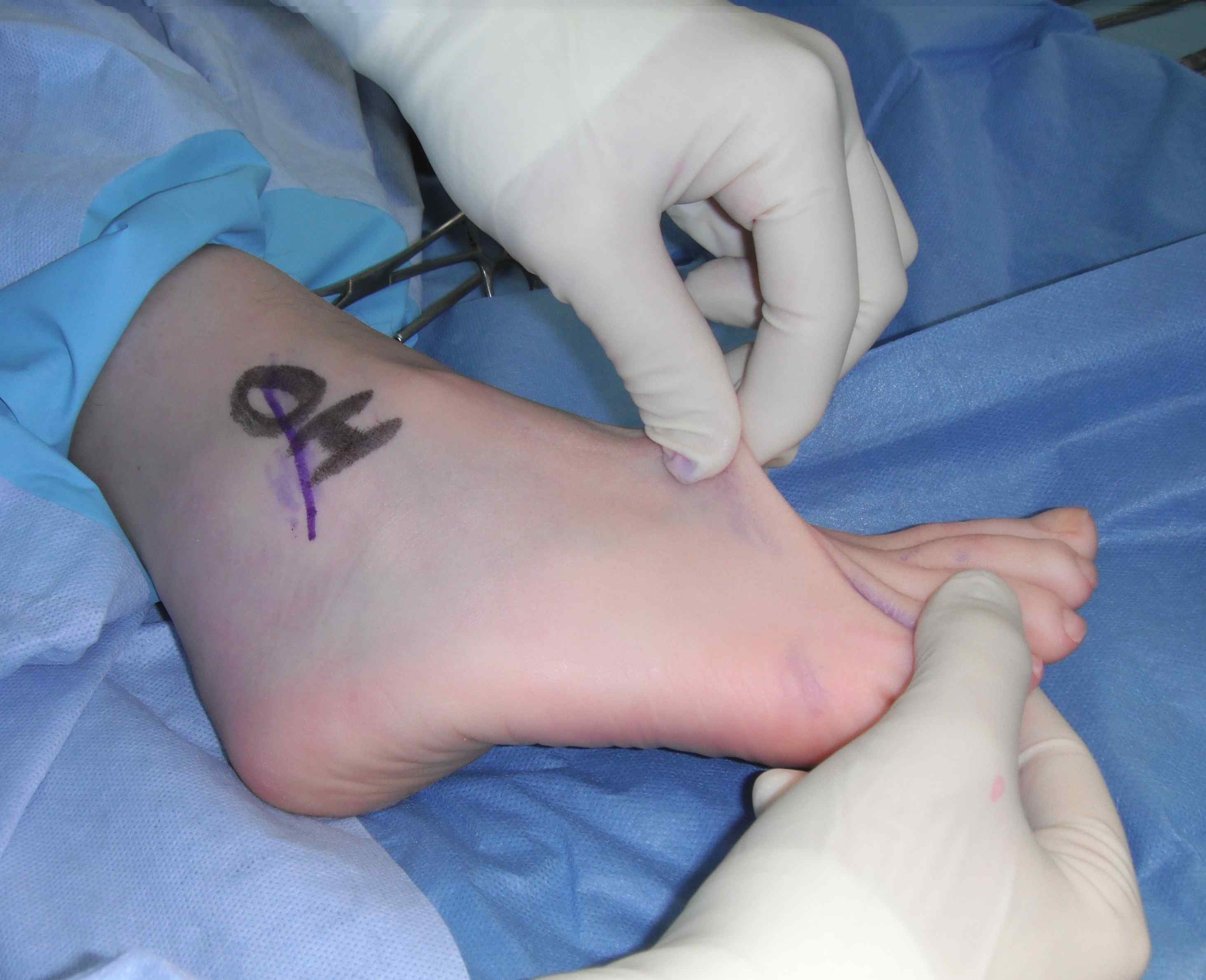 Ehler Danlos Fragile Skin